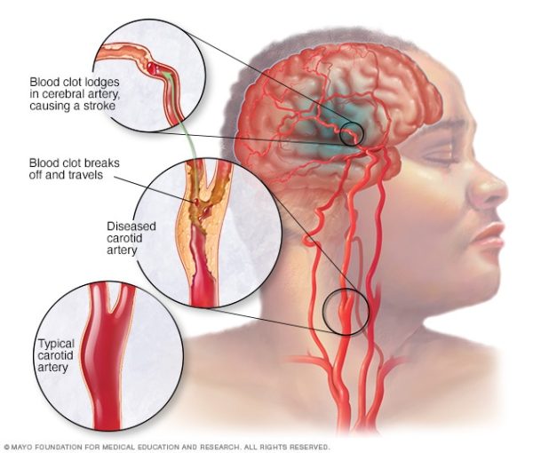 Health Emergencies 2: Strokes